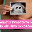 What is Twin-to-Twin Transfusion Syndrome